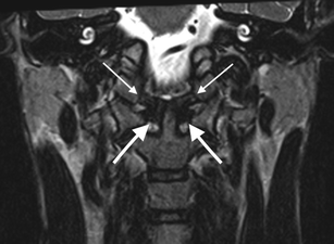 Coronal MRI of the craniocervical junction with arrows indicating the alar and transverse ligaments.