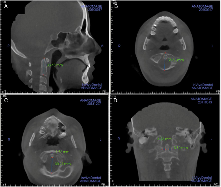 Sagittal, axial and coronal CBCT views showing the skull base, atlas, axis and atlantodental measurements.