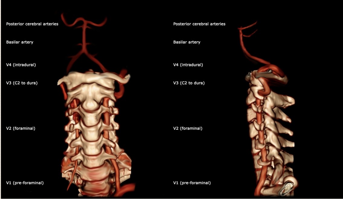 Vertebral arteries shown from the front and side, including their course through the cervical transverse foramina and around C1.