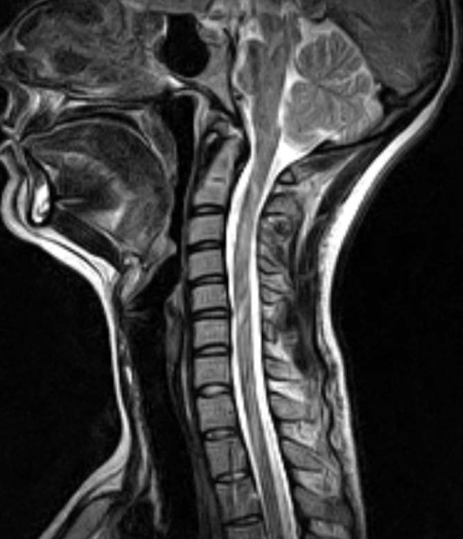 Sagittal MRI showing the brainstem, cerebellum, craniocervical junction and cervical spinal cord.