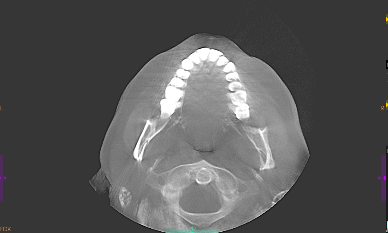 Axial CBCT view showing the atlas ring and dens beneath the skull base.