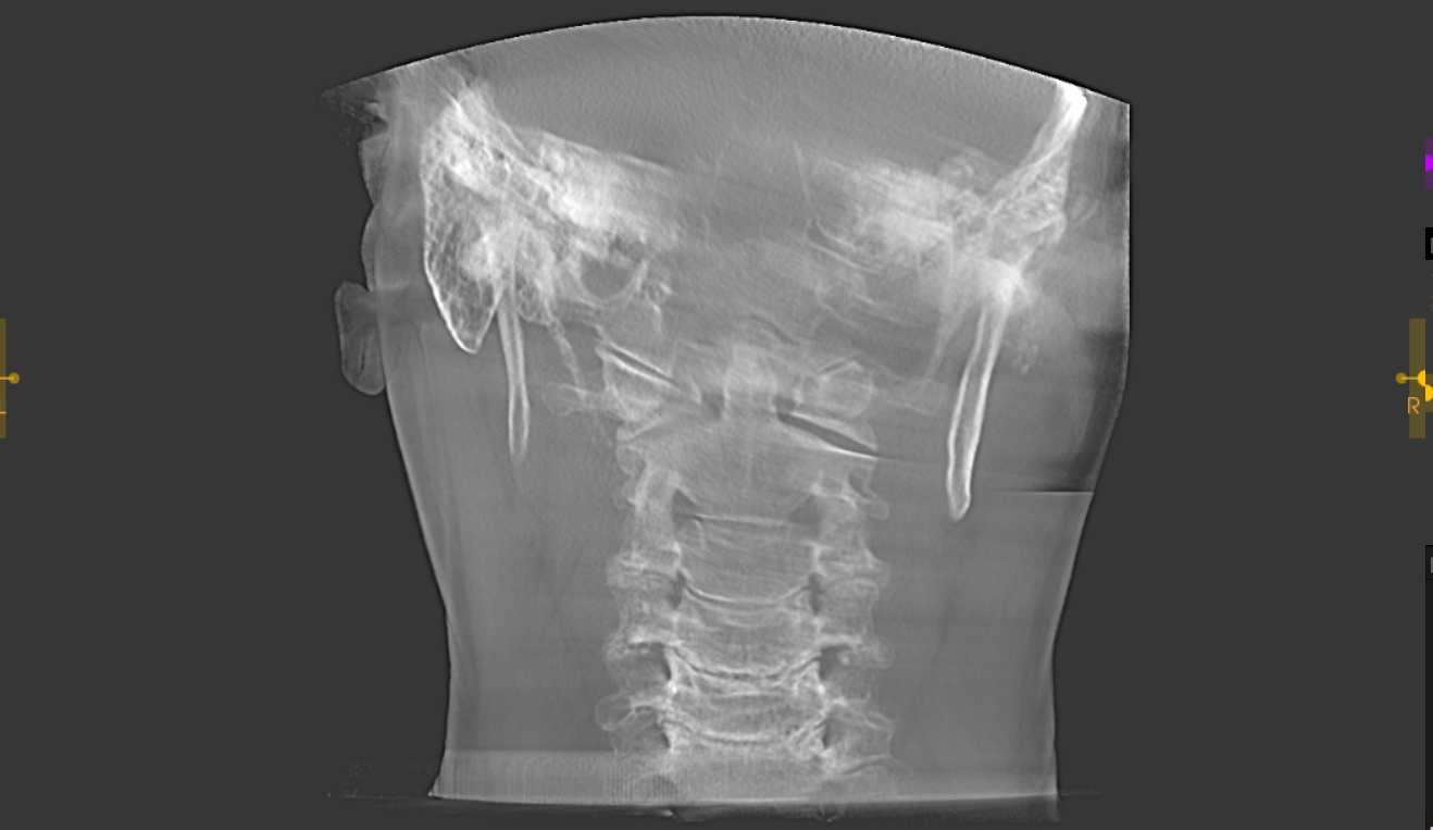 Frontal CBCT projection of the head and cervical spine.