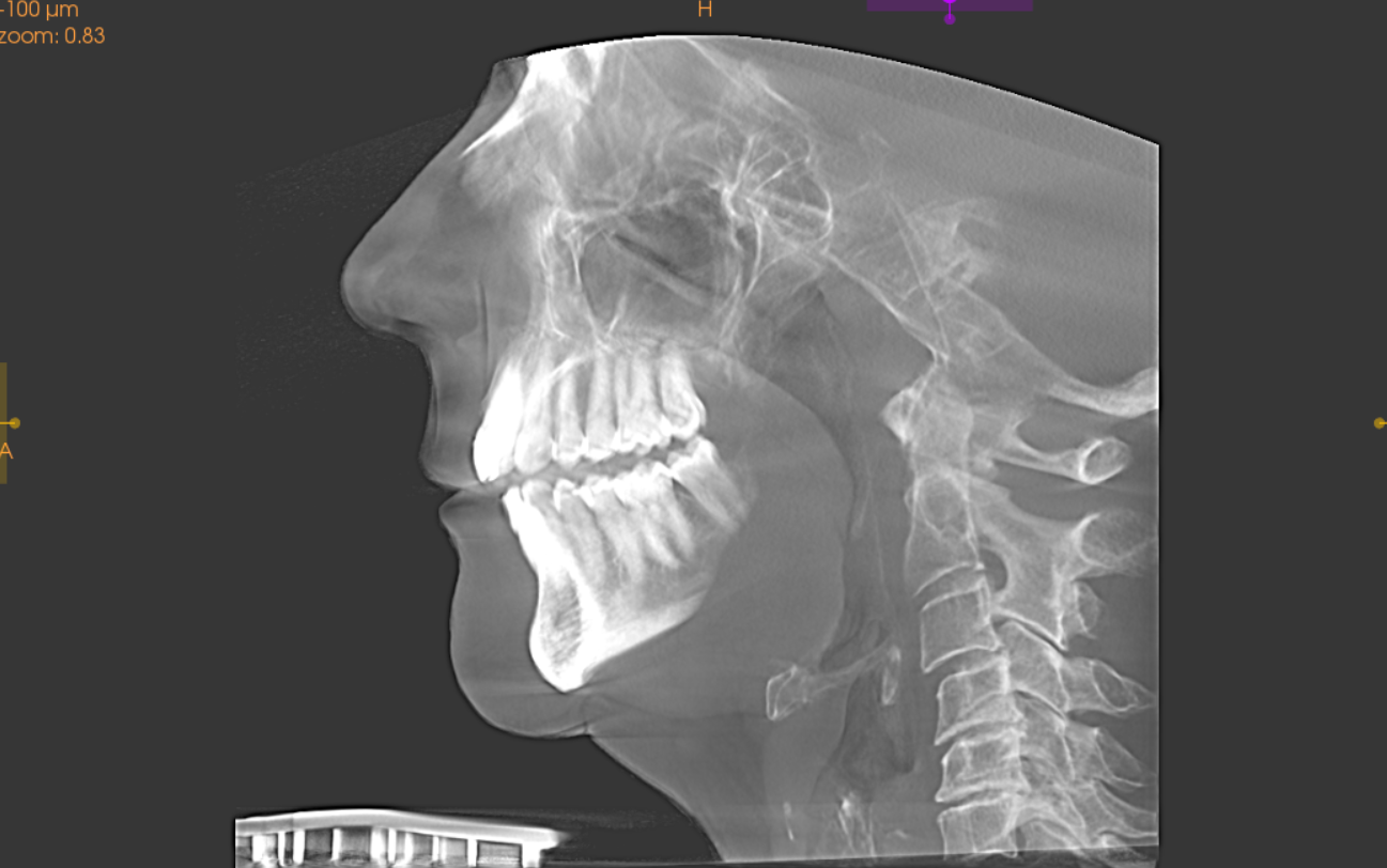 Lateral CBCT projection of the head and cervical spine.