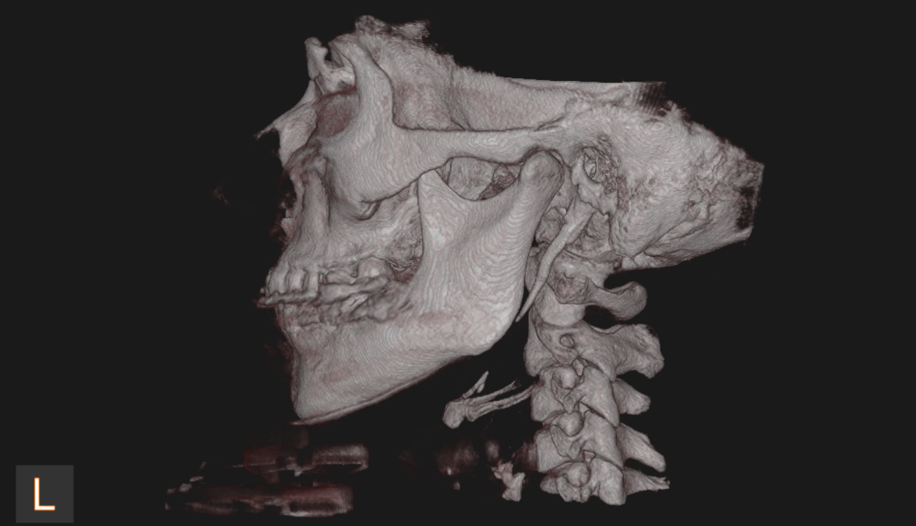 Left lateral three-dimensional CBCT reconstruction of the head and cervical spine.