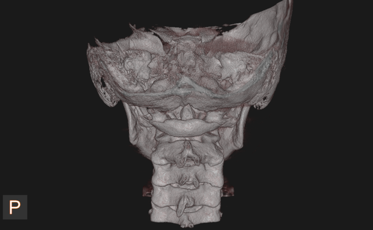 Posterior three-dimensional CBCT view of the skull base and cervical spine.