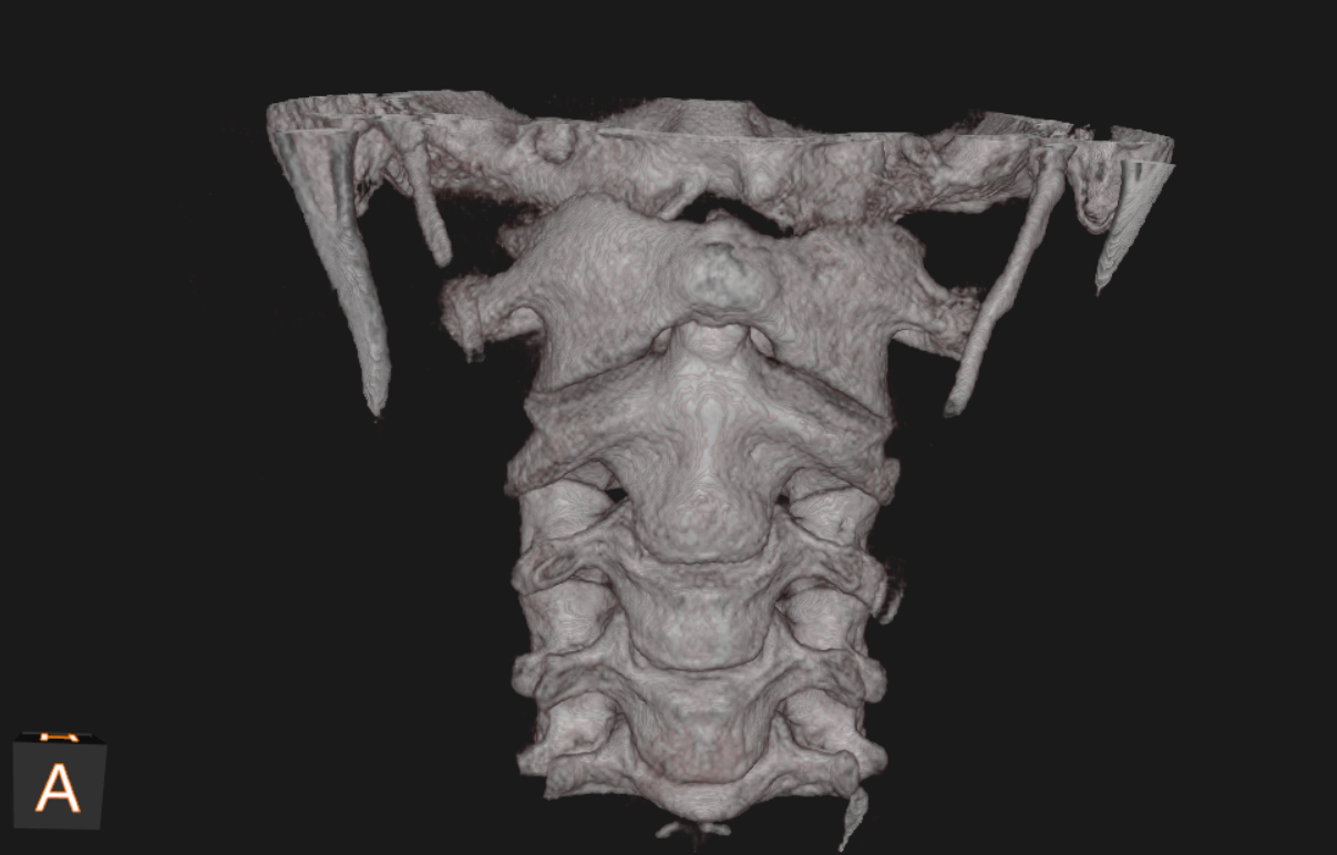 Anterior three-dimensional CBCT view of the upper cervical spine and skull base.
